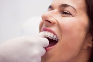 ¿Qué sabes de la ortodoncia invisible?